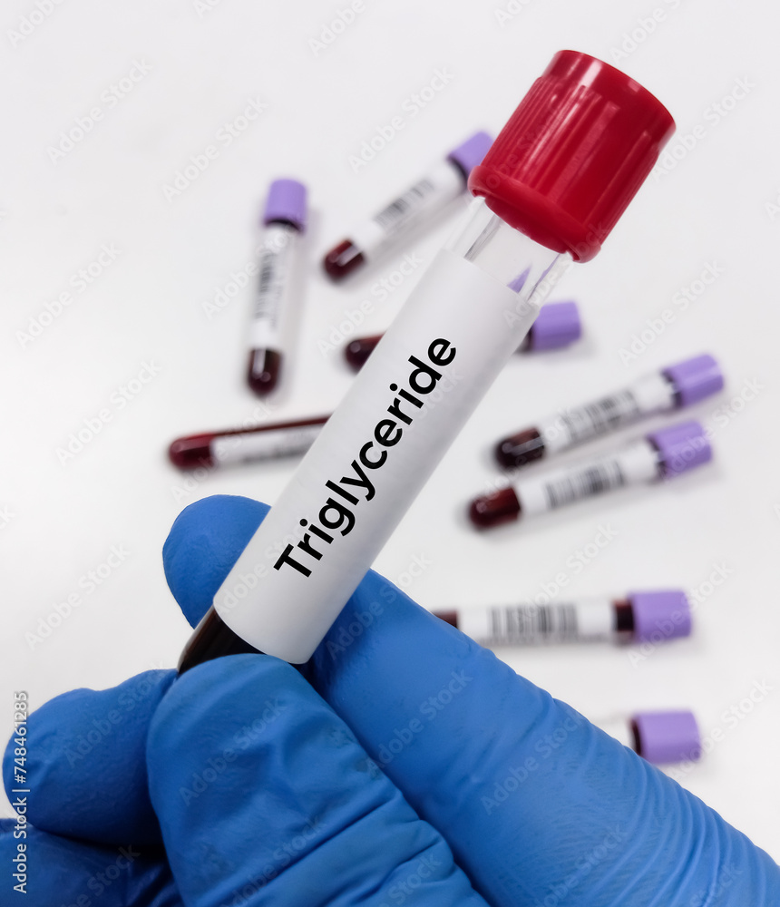 Blood sample for Triglycerides (Tg) test, to risk of heart disease and stroke. Blood sample for Triglycerides (Tg) test, to risk of heart disease and stroke.