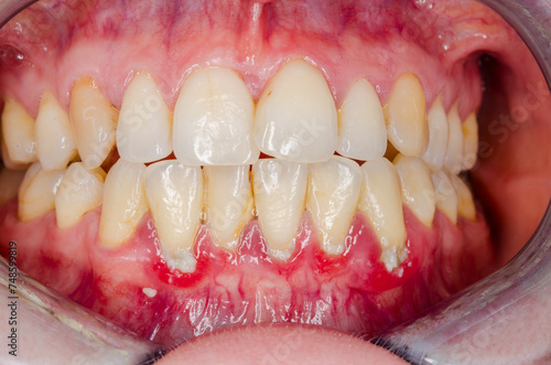 gingivitis and dental plaque