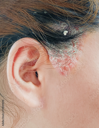 Close up sideburns girl has ringworm fungal lesions photo
