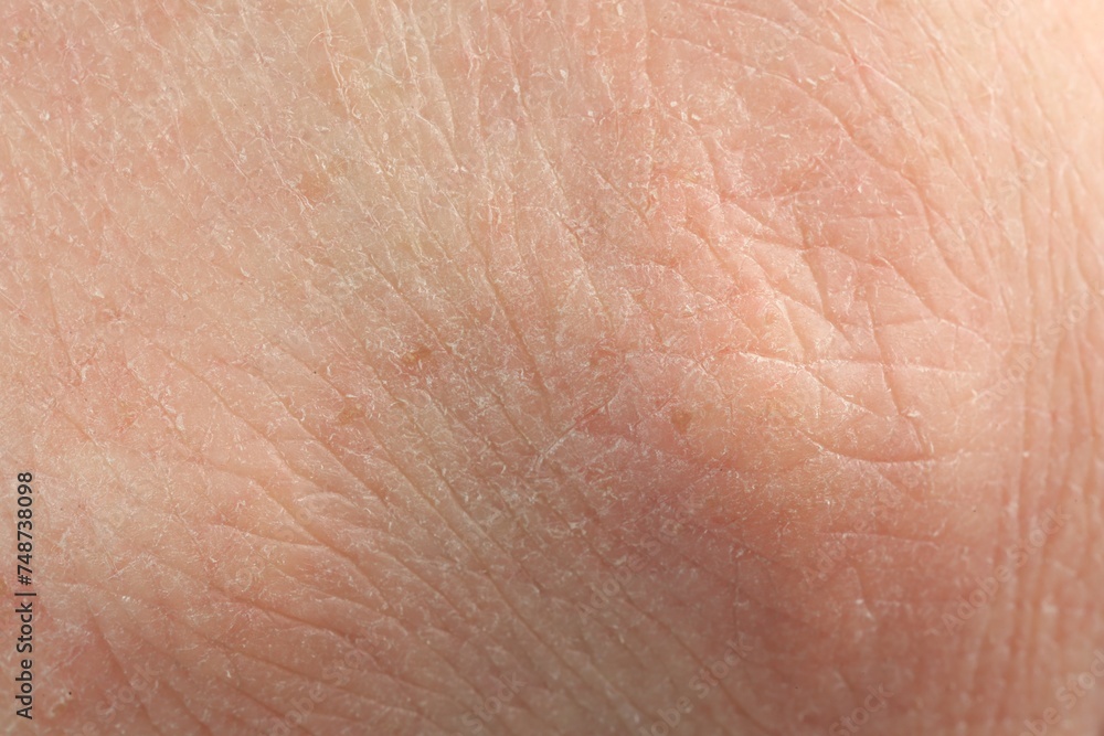 Fototapeta premium Texture of dry skin as background, macro view