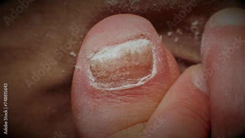 emery boards filing down a big toe nail with fungal infections. close up photo