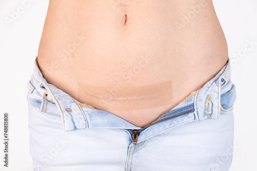 Woman is applying patch with a silicone sheeting on her scar after C-section surgery. Therapy for five months.