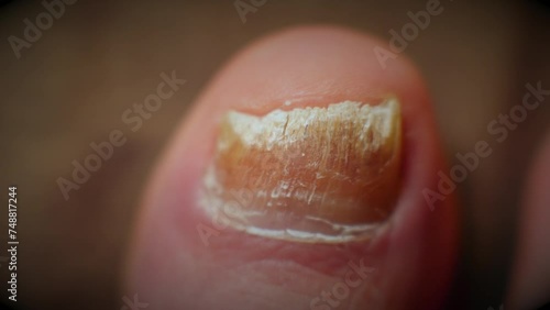  Well-lit macro shot showcasing big toe nail with fungal infection photo