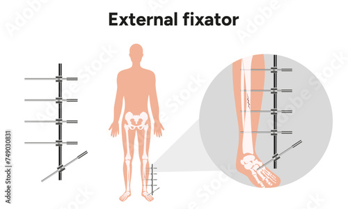 External fixator, llizarov apparatus zoom leg