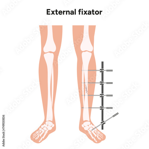 External fixator, llizarov apparatus legs