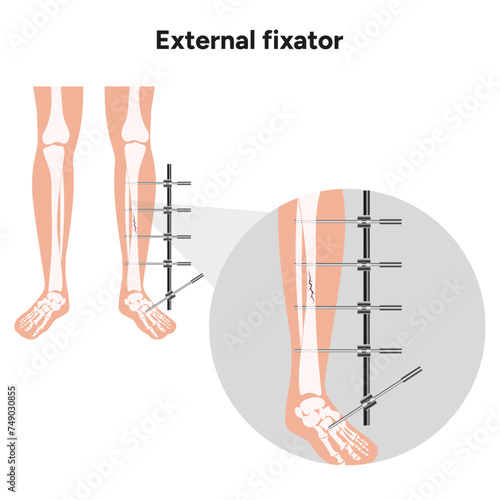 External fixator, llizarov apparatus leg zoom