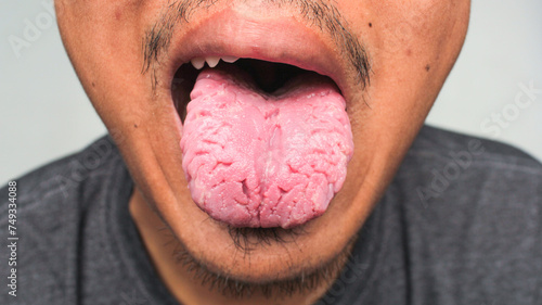 Split tongue, also known as 'scrotal tongue' or 'lingua plicata', is a condition in which crack-like lines or grooves form in the tongue photo