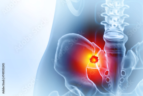 Hip bone cancer or tumor, one side pain. 3d illustration photo