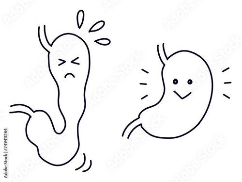 健康な胃と胃下垂の胃