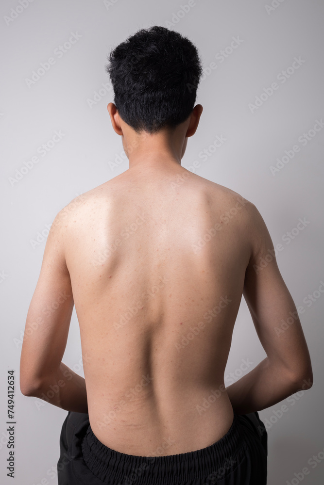 Fototapeta premium Scoliosis treatment. young man with a severe curvature of the spine isolated on gray background.