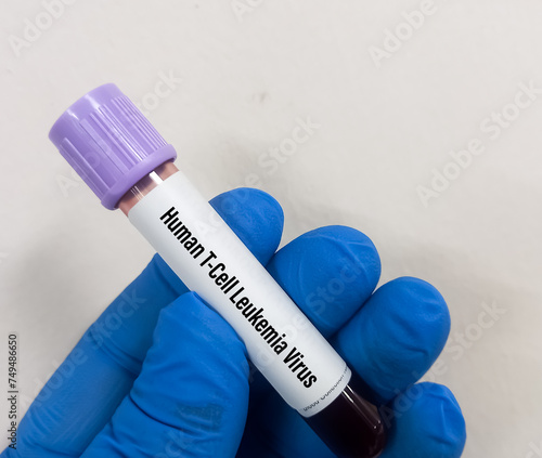 Blood sample for Human T-lymphotropic virus or Human T-cell leukemia virus or HLTV test, to diagnose a type of cancer called adult T-cell leukemia or Lymphoma. photo