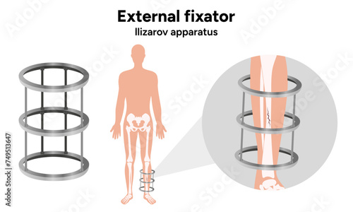 External fixator, llizarov apparatus with man and zoom leg