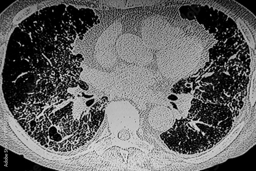 CAT- Scan of interstitial lung disease secondary to scleroderma.