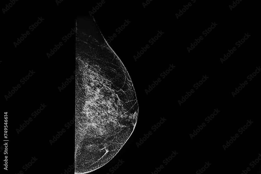 Mammography: 3D tomosynthesis without prosthesis. Medical themes