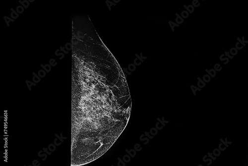 Mammography: 3D tomosynthesis without prosthesis. Medical themes