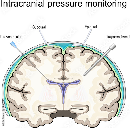 Intracranial pressure. ICP monitoring photo