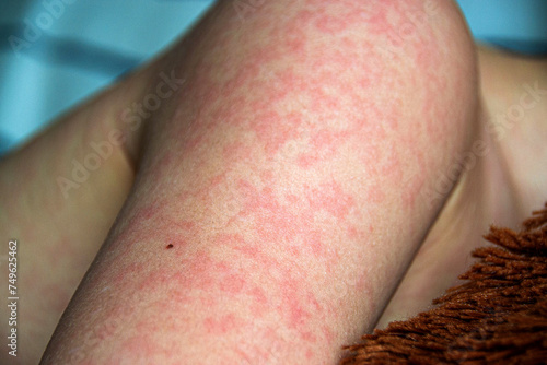 Viral disease. Measles rash on the body of the child. Allergy