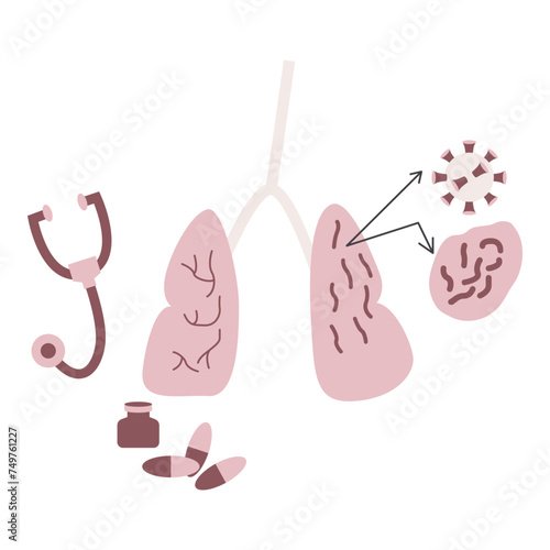 Lung cancer disease. Vector illustration in flat style with cancer disease theme. Editable vector illustration.
