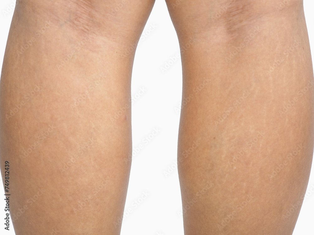 Stretch marks on legs skin of woman on white background. Closeup photo, blurred. Stretch marks on legs skin of woman on white background. Closeup photo, blurred.