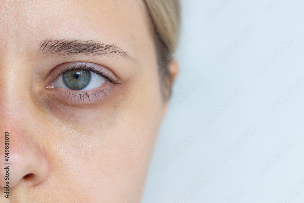 Cropped shot of a young caucasian woman's face with dark circle under eye isolated on a grey background. Bruise under the eyes are caused by fatigue, nervousness, lack of sleep, insomnia, stress Cropped shot of a young caucasian woman's face with dark circle under eye isolated on a grey background. Bruise under the eyes are caused by fatigue, nervousness, lack of sleep, insomnia, stress