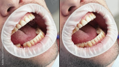 Before and after dental tooth implantation. Split screen. Dental surgery photo