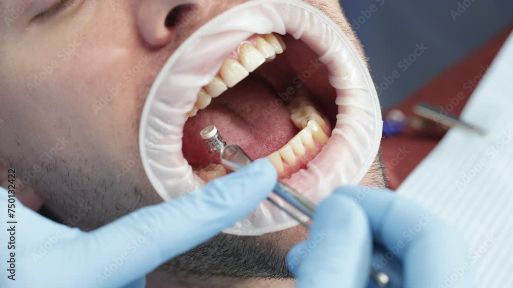 Tightening the healing abutment with a torque wrench, often referred to as a healing cap or