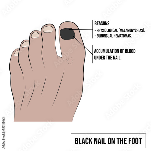 Black nail on the foot or also called subungual hematoma.