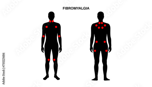 Fibromyalgia medical poster
