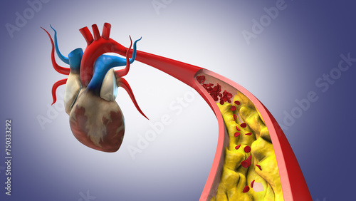 Cholesterol plaque in artery with human heart