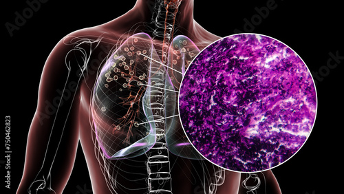 Lungs affected by silicosis, 3D illustration and micrograph