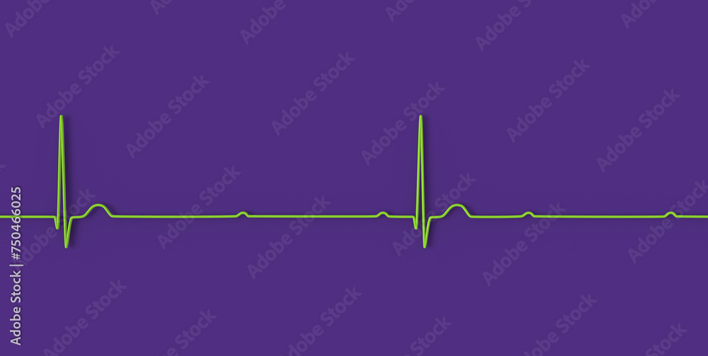 ECG of 3rd degree AV block, 3D illustration ECG of 3rd degree AV block, 3D illustration