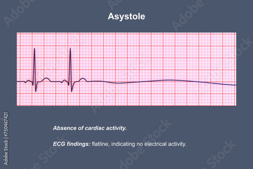 ECG in asystole, 3D illustration photo