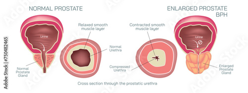 The prostate gland is located just below the bladder in men and surrounds the top portion of the tube that drains urine from the bladder or urethra vector illustration. Students study material.