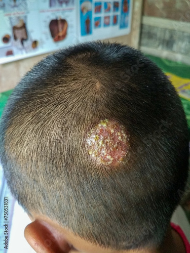 Scalp ringworm with secondary bacteria infection of Asian child