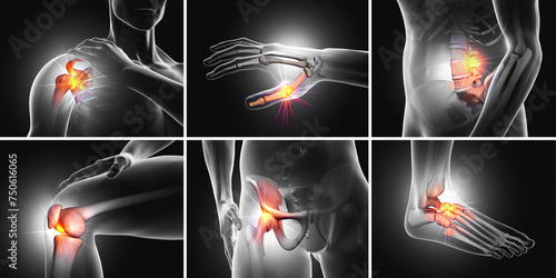 Painful joints, medical 3D illustration photo