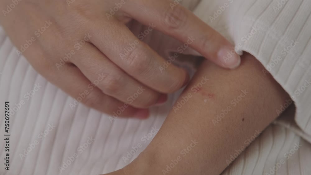 Young Asian woman has itchy and red spots or rash on the skin on her ...