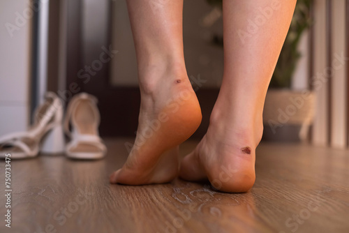 Close-up of female feet with calluses, uncomfortable shoes and orthopedic insoles. © Svetlana Golovko