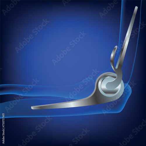 Treatment of the radial head. Total joint replacement. Medical banner with blue background. Vector isolated illustration