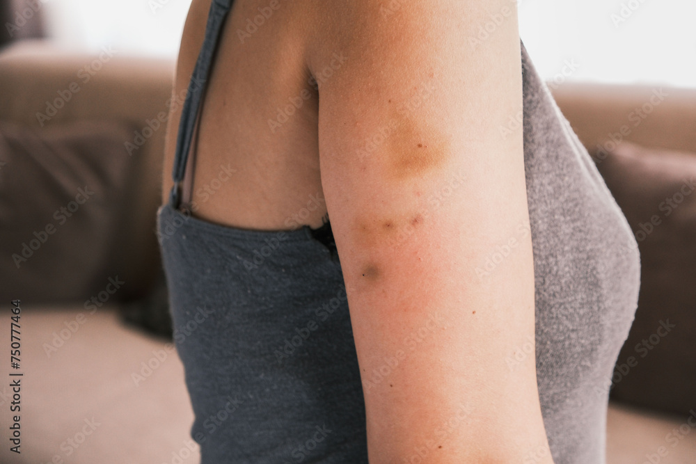 Foto de Bruising on the arm caused by previous injections. Blood