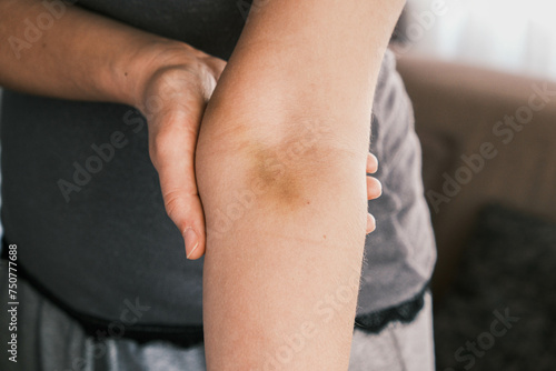 Bruising on the arm caused by blood donation or serum injection, woman holding her arm