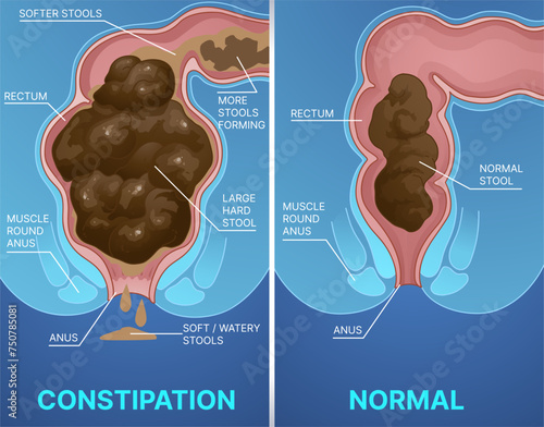 Constipation, normal stool. Before, after. Healthcare infographic. Vector illustration.