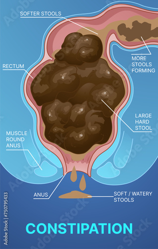 Constipation.  Healthcare infographic. Healthcare illustration. Vector illustration.