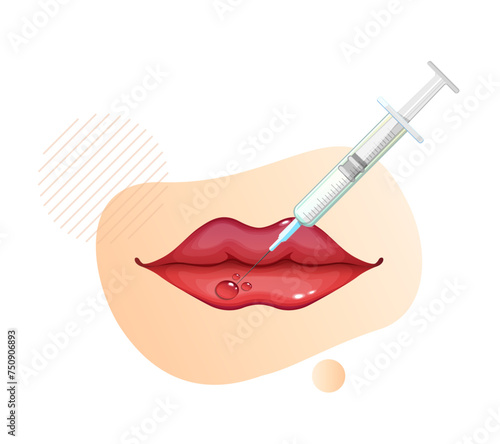 Botulinum Toxin Injection on Lips - Stock Illustration