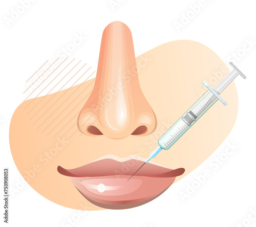 Botulinum Toxin Injection on Lips - Stock Illustration