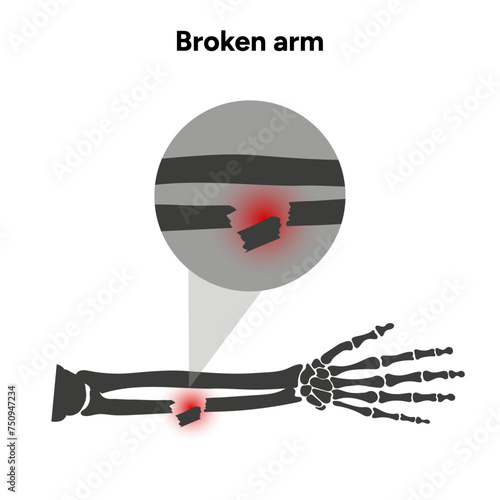 Broken arm, ulna and radius, injuries arm, Significant trauma