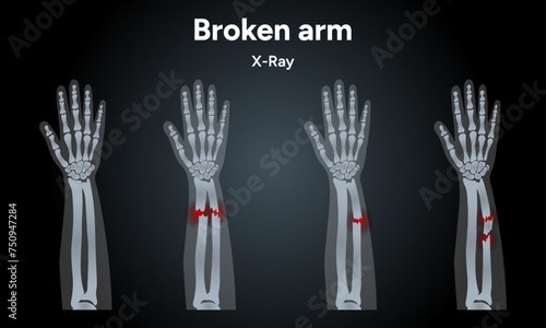 Broken arm, ulna and radius, injuries arm, Significant trauma x-ray
