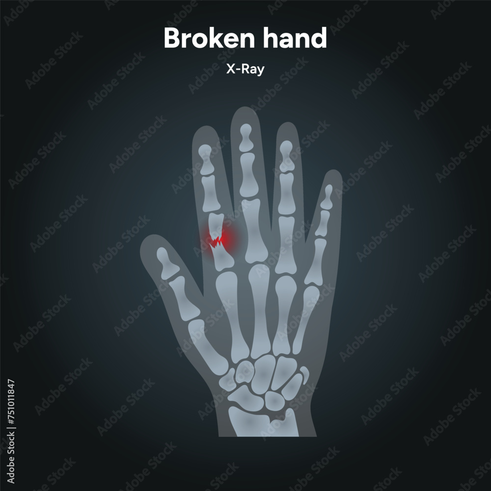 Naklejka premium Hand bones skeletons x-ray. Broken arm, ulna and radius, injuries arm, Significant trauma, falls