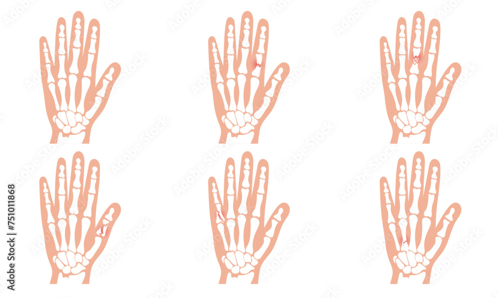 Fototapeta premium Hand and broken hand bone skeletons. Broken arm, ulna and radius, injuries arm, Significant trauma, falls