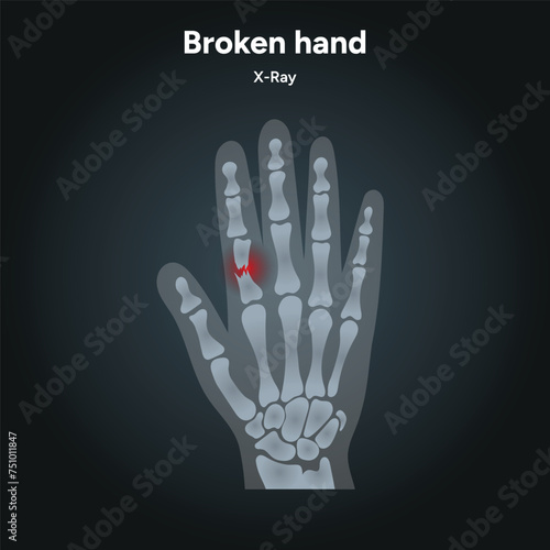 Hand bones skeletons x-ray