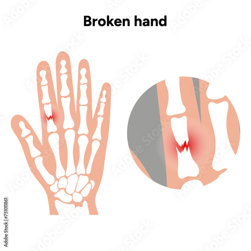 Hand and broken hand bone skeletons. Broken arm, ulna and radius, injuries arm, Significant trauma, falls